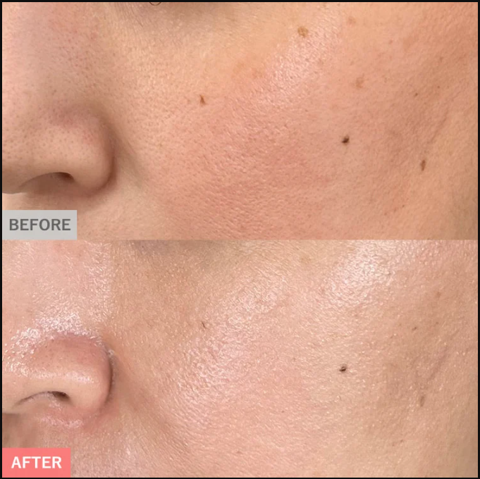 TCBシミ取り症例写真①