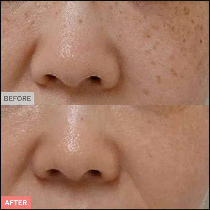 TCBシミ取り症例写真②