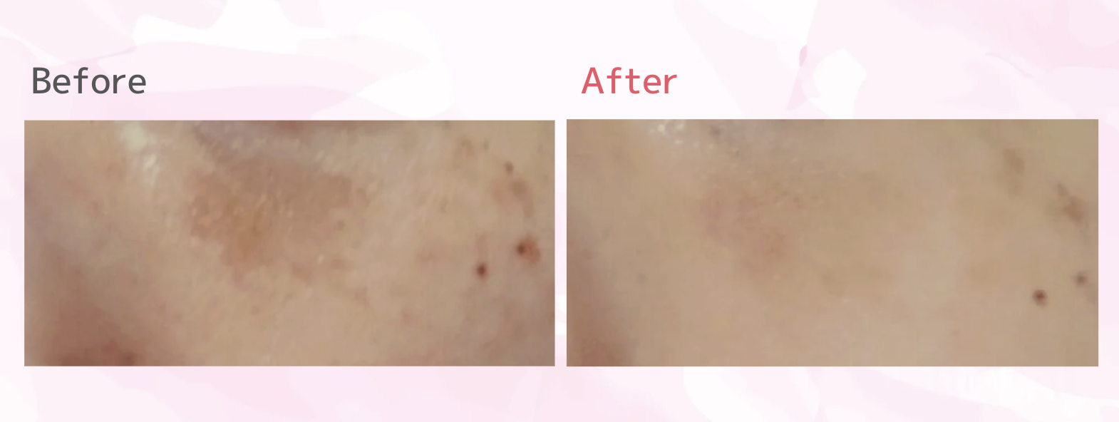 TCB シミ取り　口コミ