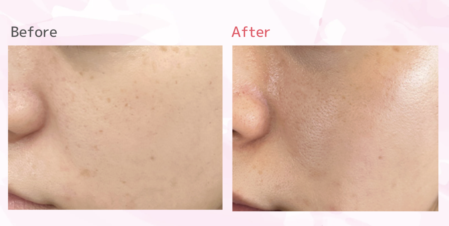 TCB シミ取り　口コミ