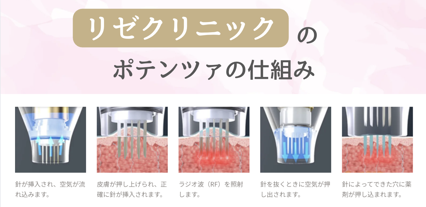 リゼクリニック　ポテンツァ　口コミ