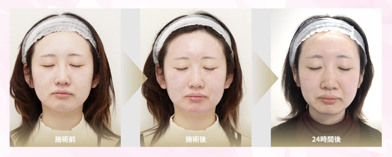 リゼクリニック　ポテンツァ　口コミ