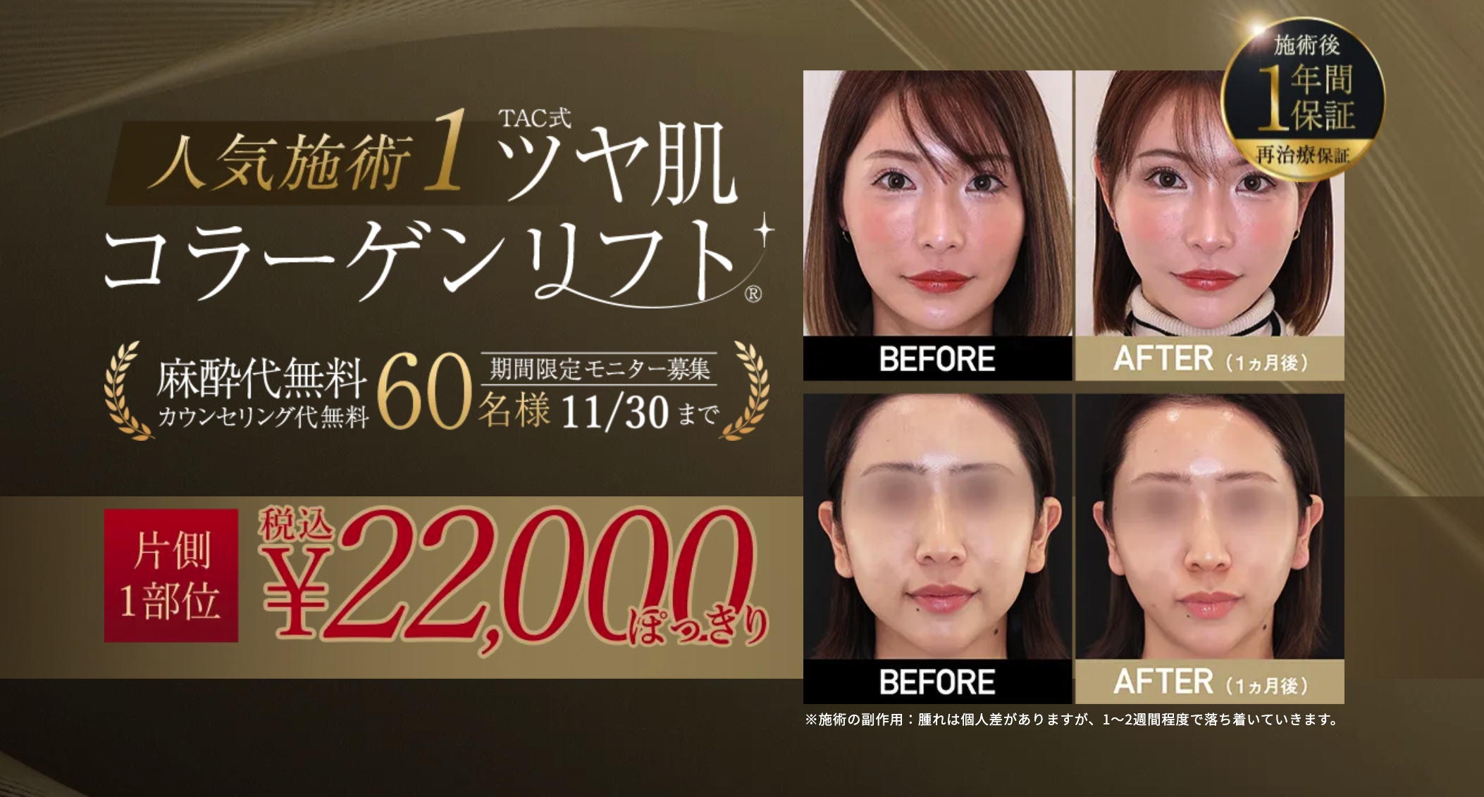 TAクリニック　糸リフト　口コミ