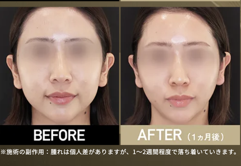 TAクリニック　糸リフト　口コミ