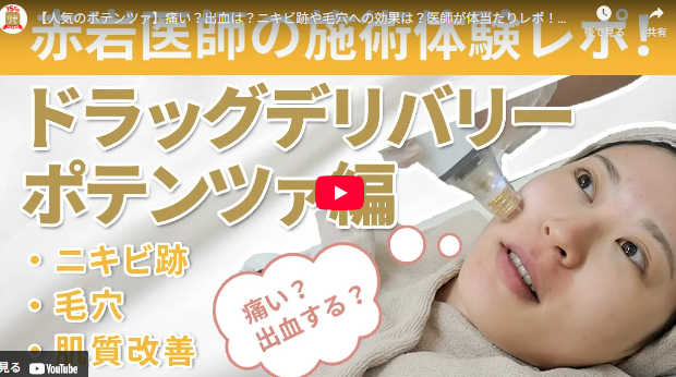 リゼクリニックのポテンツァを実際に体験してみたYouTube動画