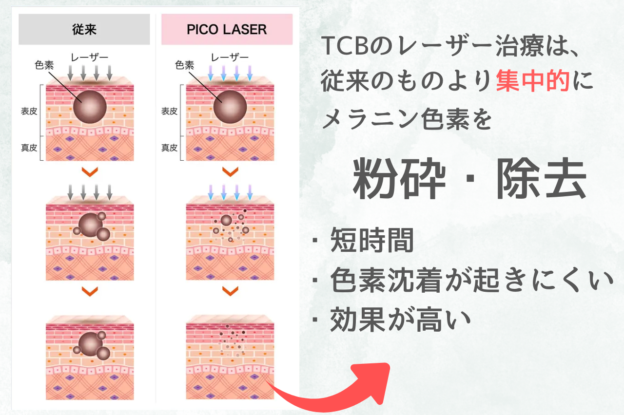 TCB シミ取り　口コミ