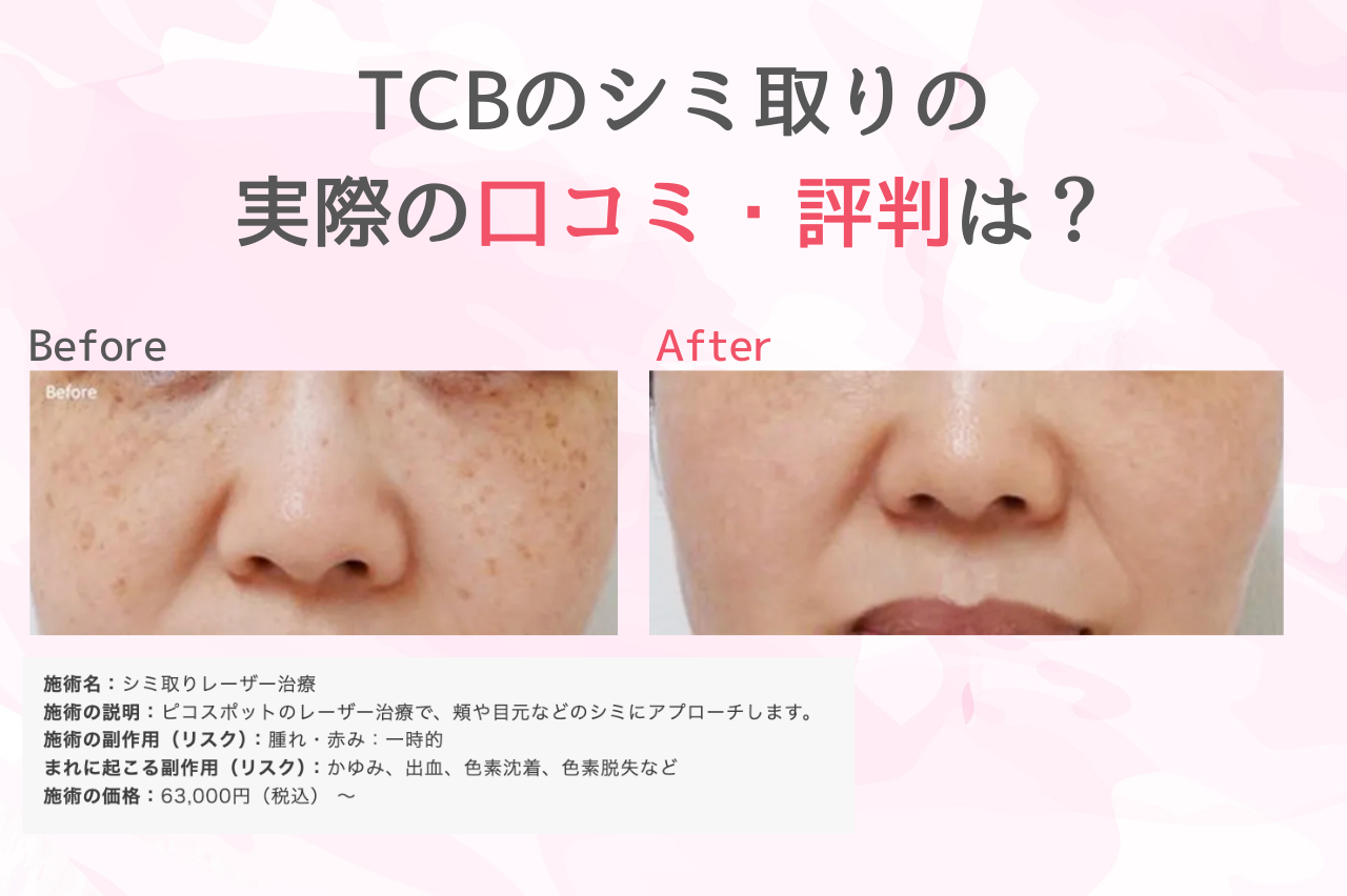TCB シミ取り　口コミ　評判
