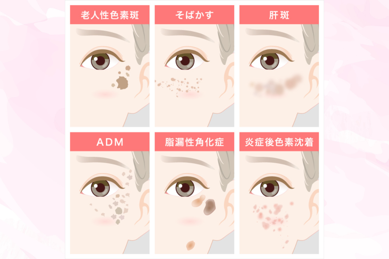 TCB シミ取り　口コミ