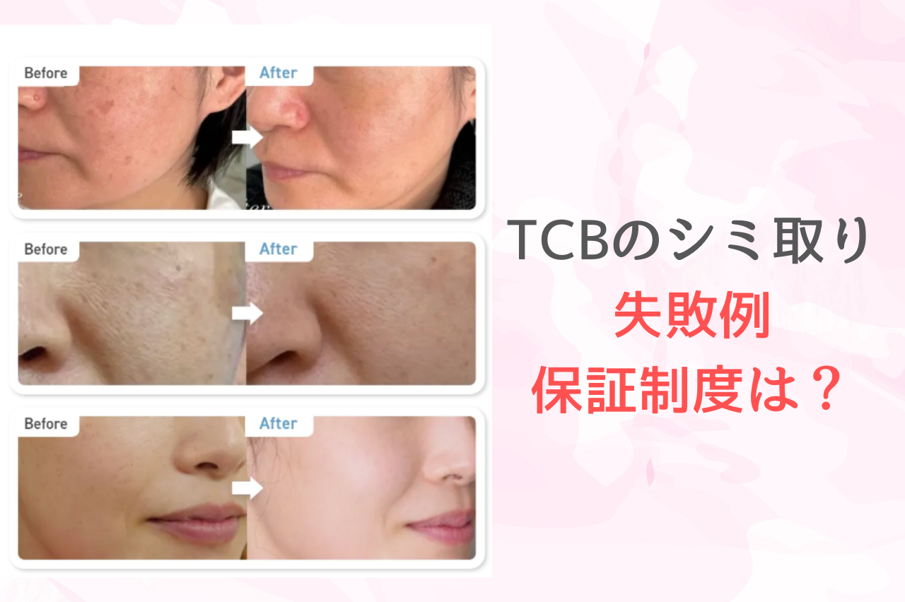 TCBのシミ取りで失敗することはある？保証制度と注意点を解説