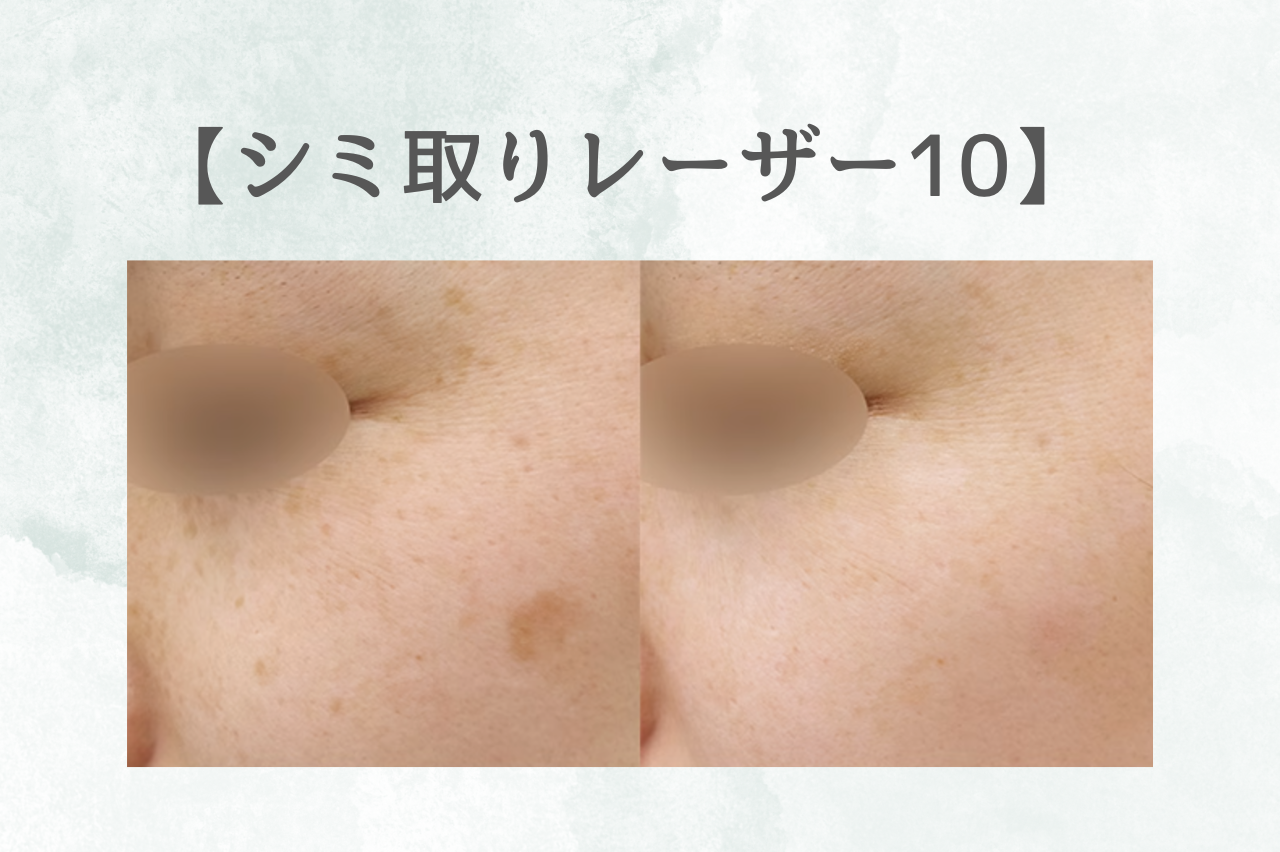 湘南　シミ取りレーザー10 口コミ
