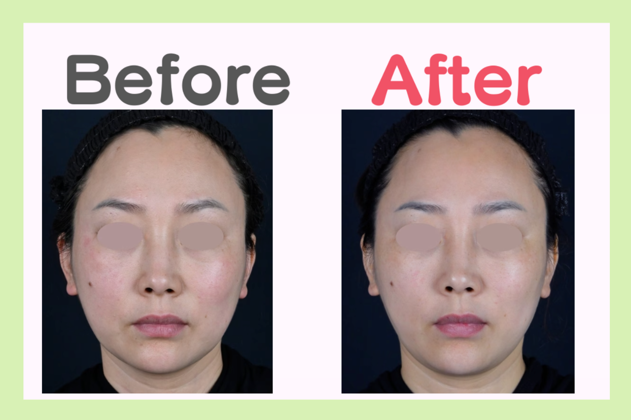 ウルセラ　湘南　口コミ　ハイフ