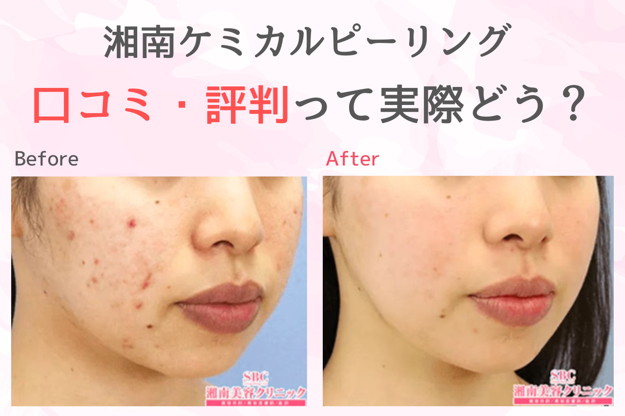 湘南美容のケミカルピーリングって実際どう？口コミでチェック！