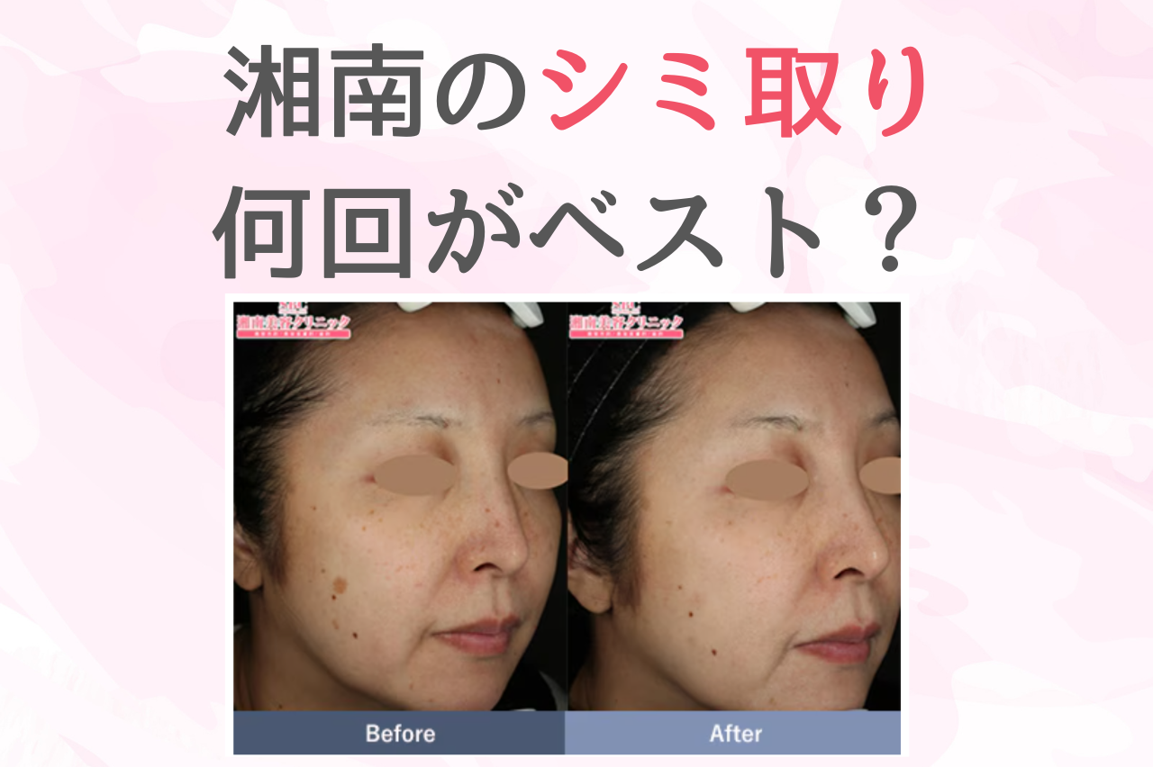 口コミで分析 | 湘南のシミ取りの最適な回数は？