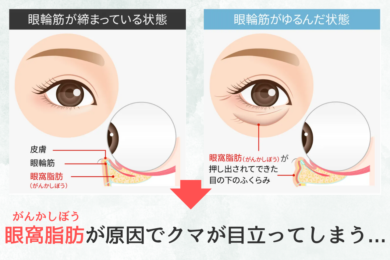 TAクリニック　クマ取り　口コミ