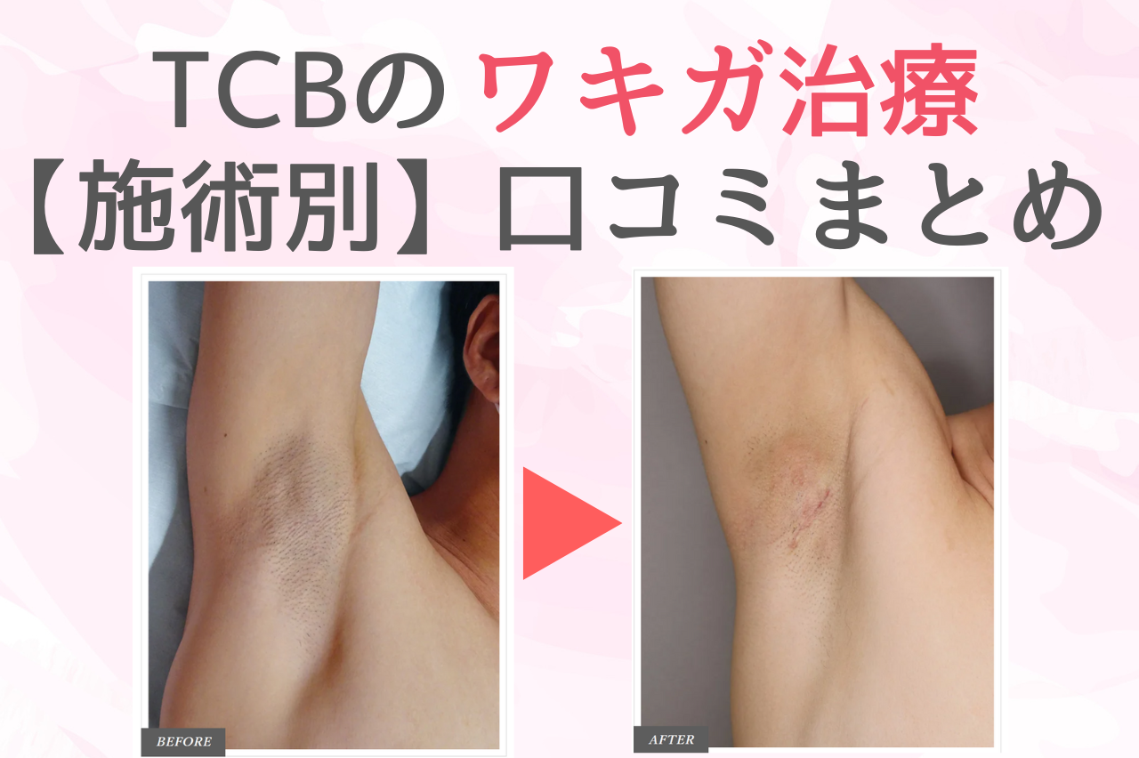 TCB ワキガ治療　口コミ