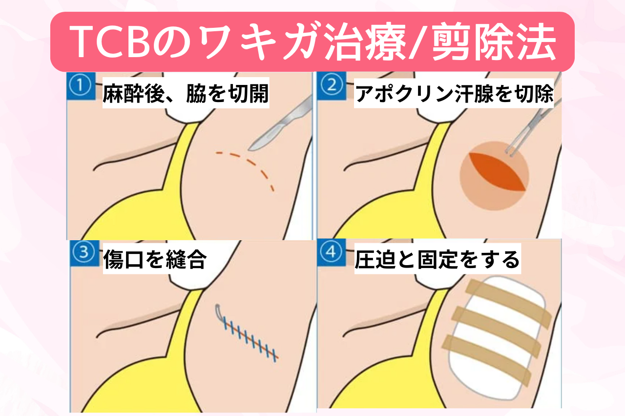 TCB ワキガ治療　口コミ