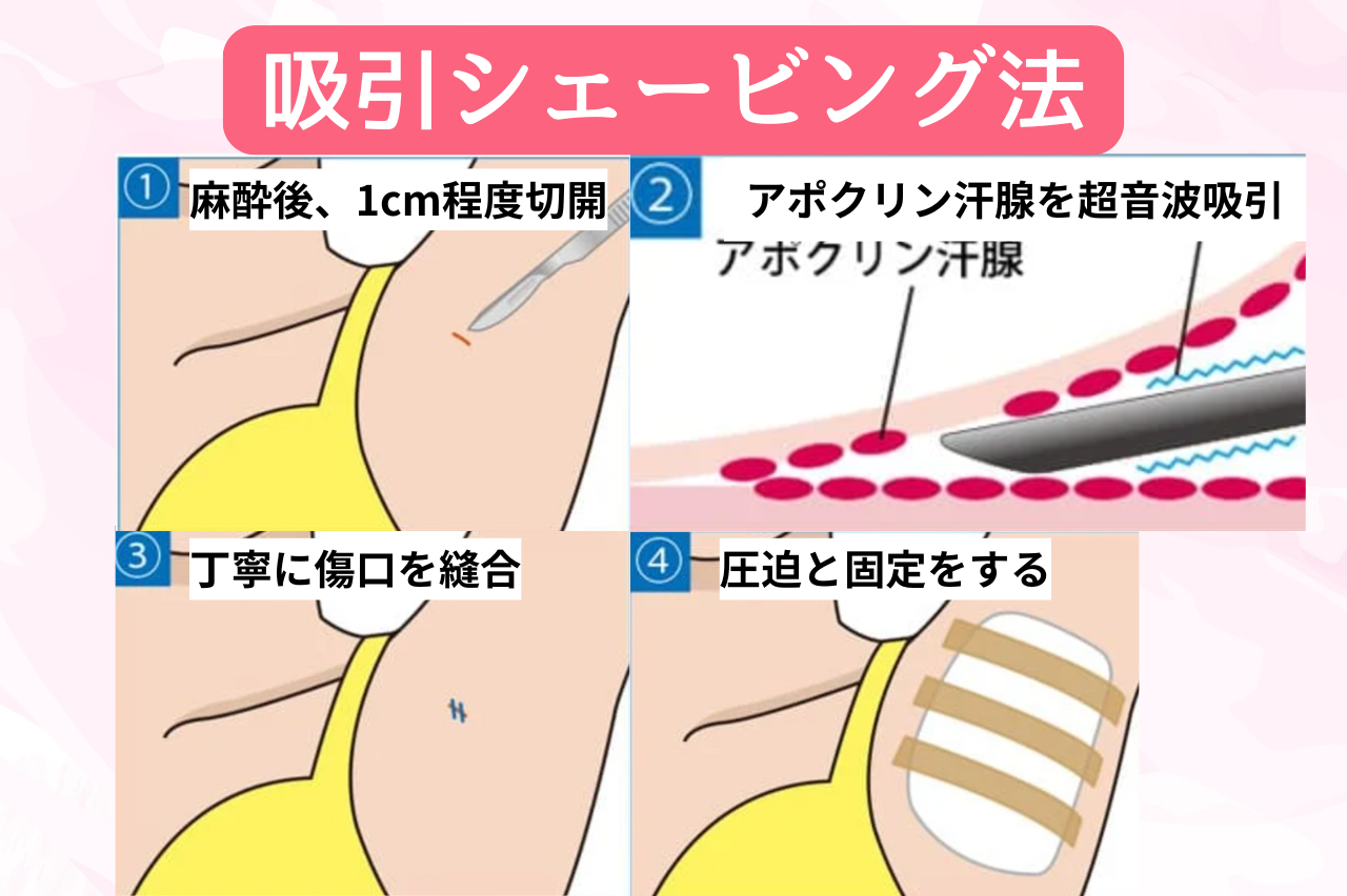TCB ワキガ治療　口コミ