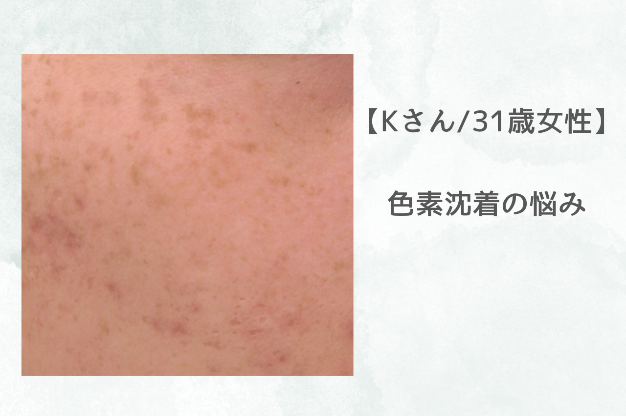 シロノクリニック　シミ取り　口コミ
