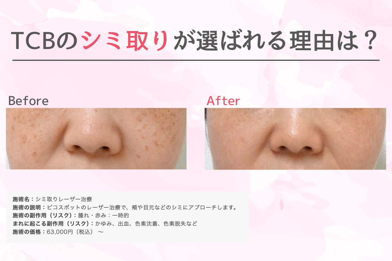 TCBのシミ取りが選ばれる理由は？