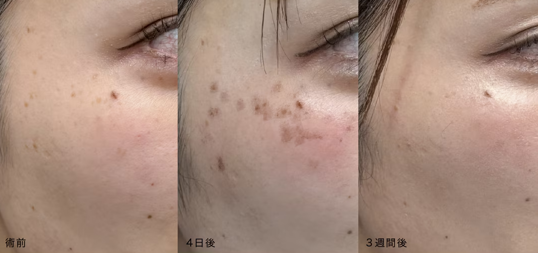 湘南のシミ取りレーザー10の症例