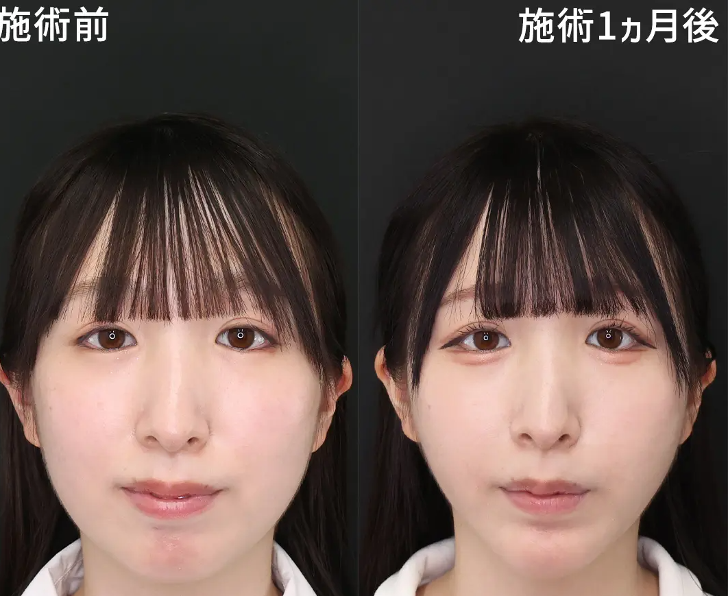 TAクリニックのほうれい線に対するヒアルロン酸注射 症例2