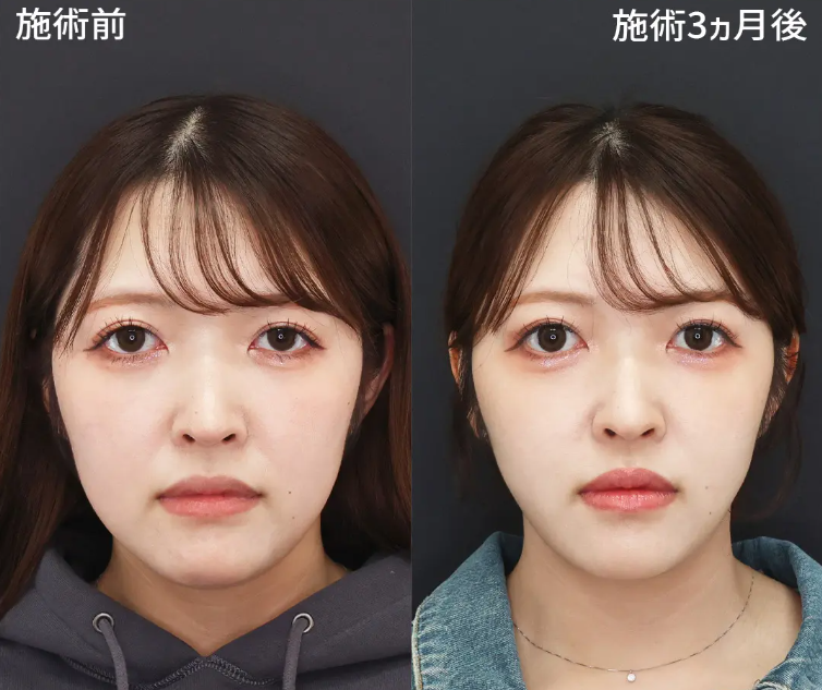 TAクリニックのほうれい線に対するヒアルロン酸注射の症例