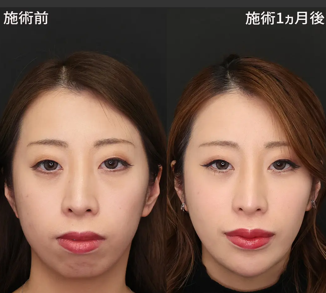 TAクリニックの唇ヒアルロン酸注射 症例2