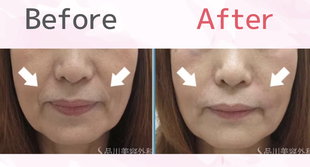 品川美容外科のヒアルロン酸注射の口コミ・評判を徹底調査