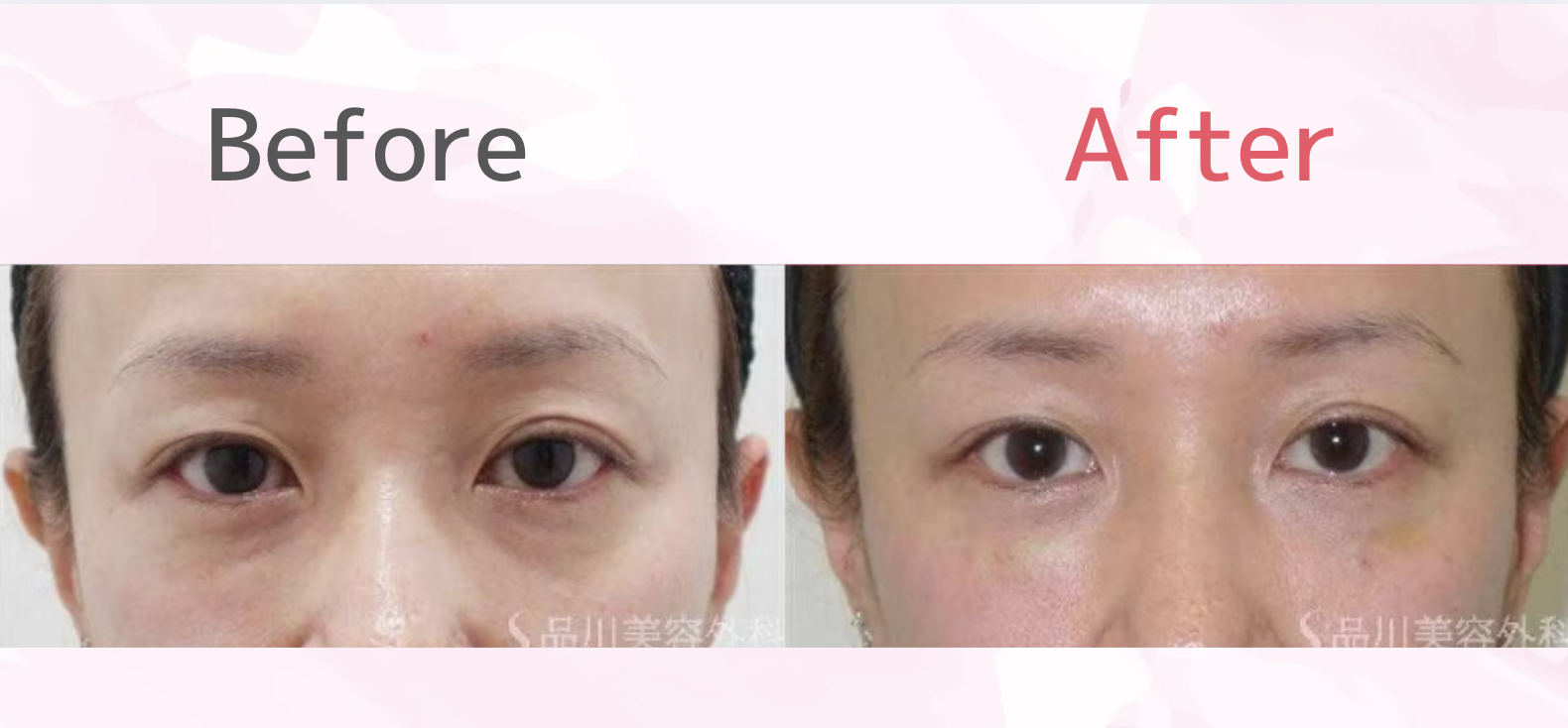 品川美容外科のヒアルロン酸注射の口コミ・評判を徹底調査