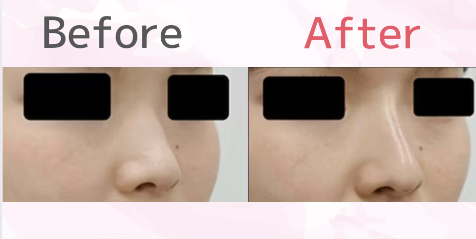 鼻ヒアルロン酸注射の口コミ