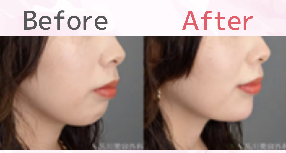 顎ヒアルロン酸注射の評判