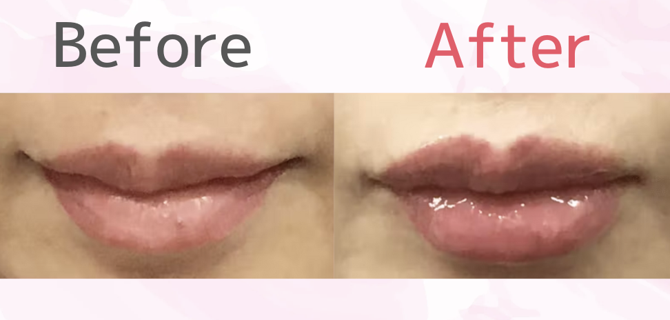 唇・額・頬ヒアルロン酸注射の口コミ