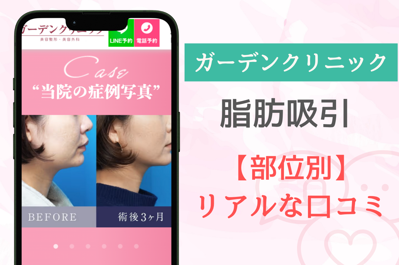 【部位別】ガーデンクリニックの脂肪吸引口コミを紹介