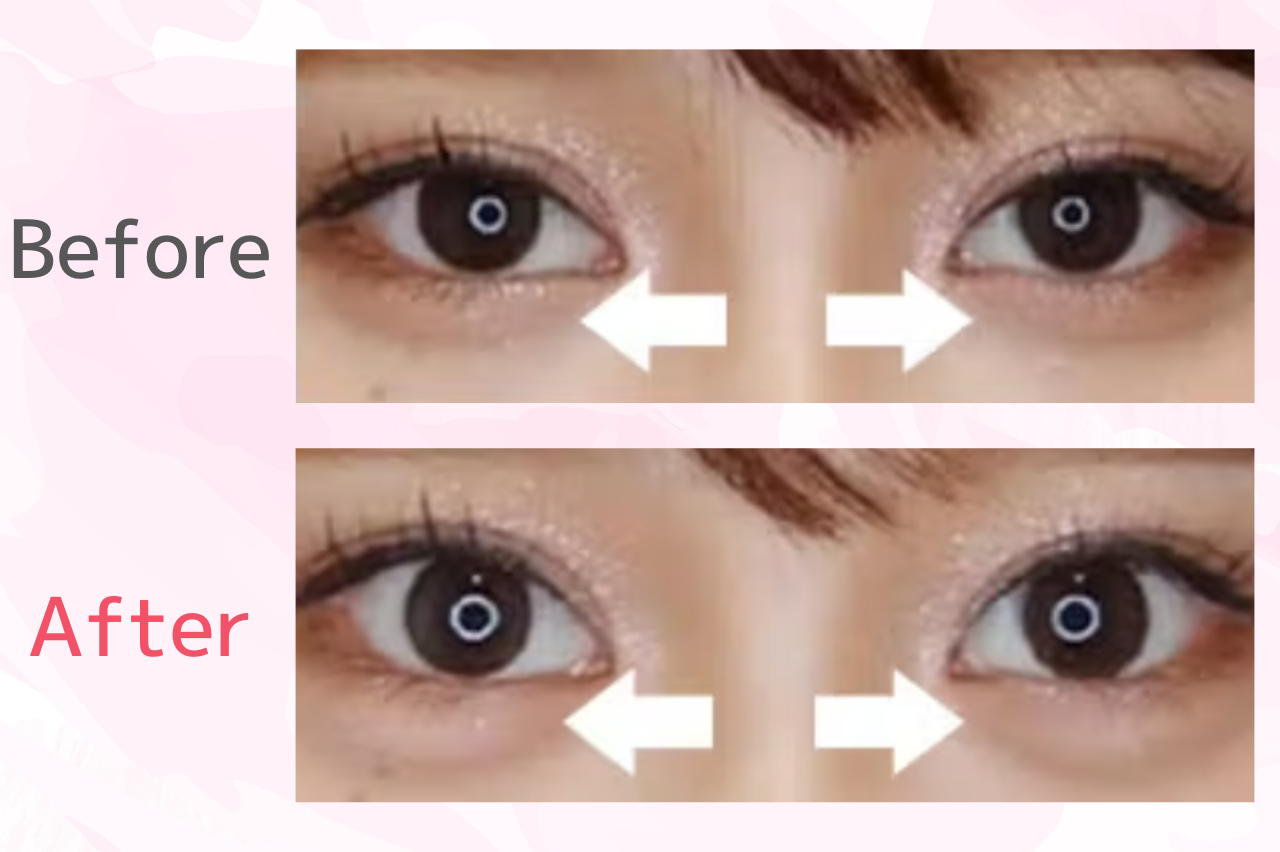 品川美容外科のヒアルロン酸注射の口コミ・評判を徹底調査