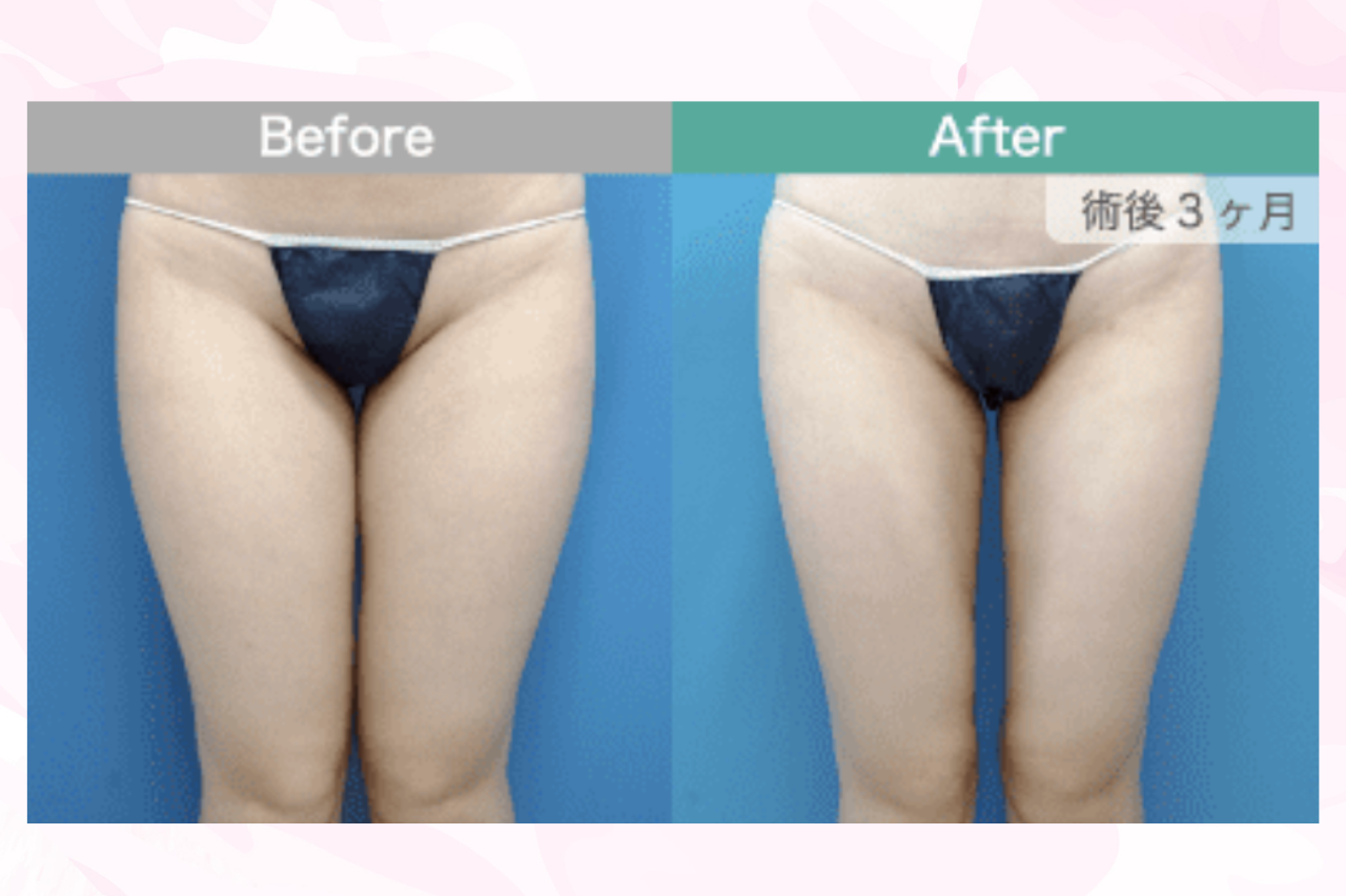 ガーデンクリニック　太ももの脂肪吸引　口コミ