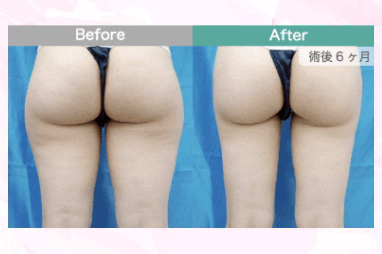 ガーデンクリニック　太ももの脂肪吸引　口コミ