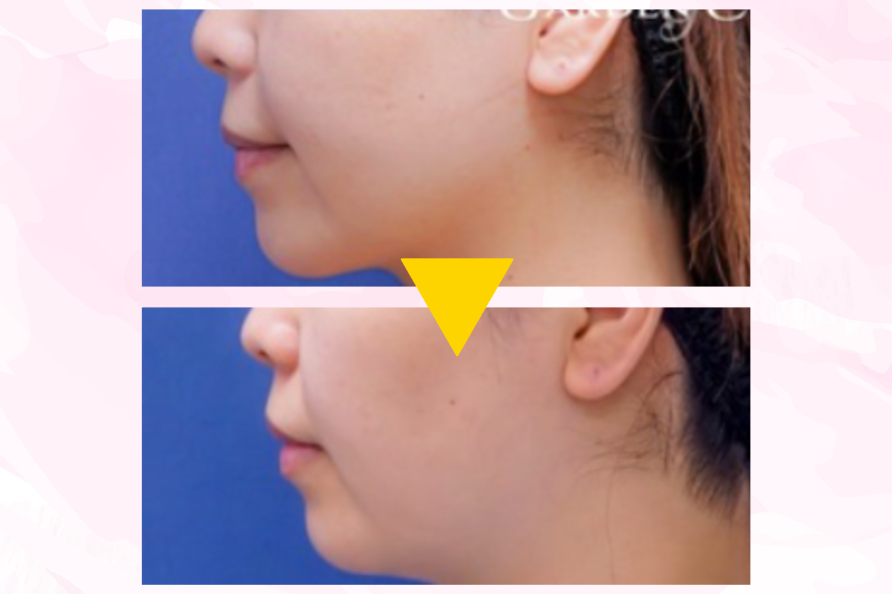 顔の脂肪吸引を受けた人の口コミ　ガーデンクリニック