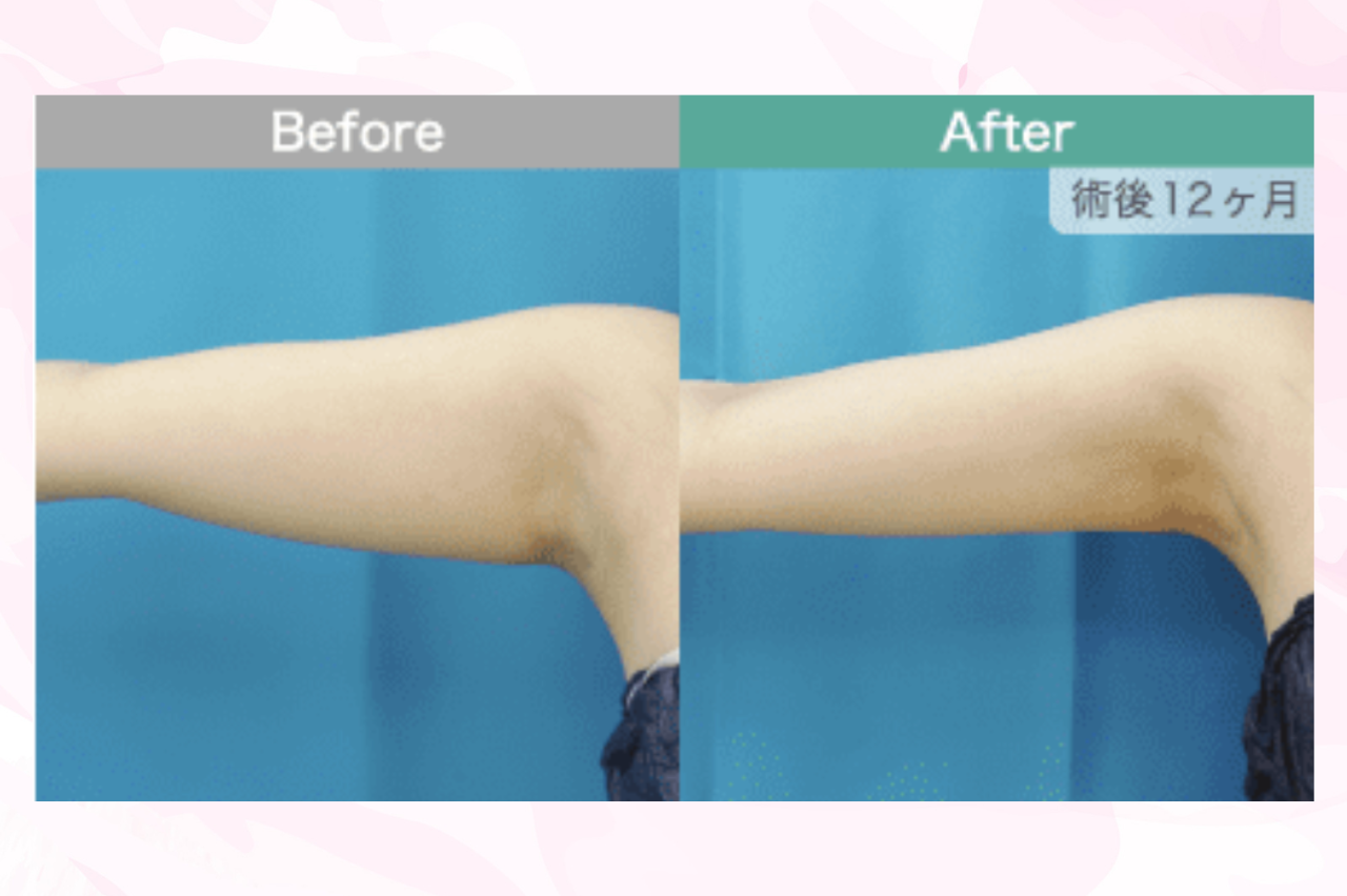 二の腕の脂肪吸引を受けた人の口コミ　ガーデンクリニック