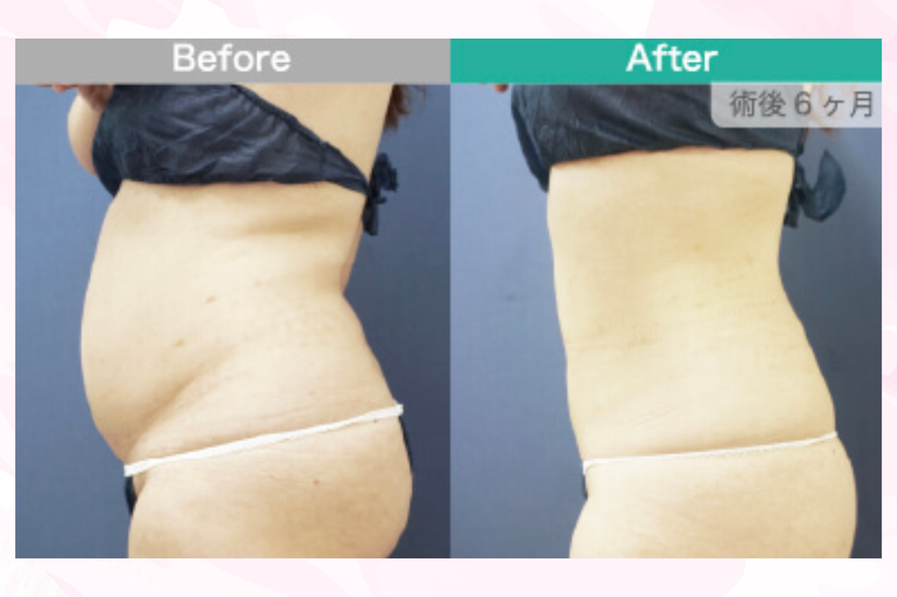 お腹周りの脂肪吸引を受けた人の口コミ　ガーデンクリニック
