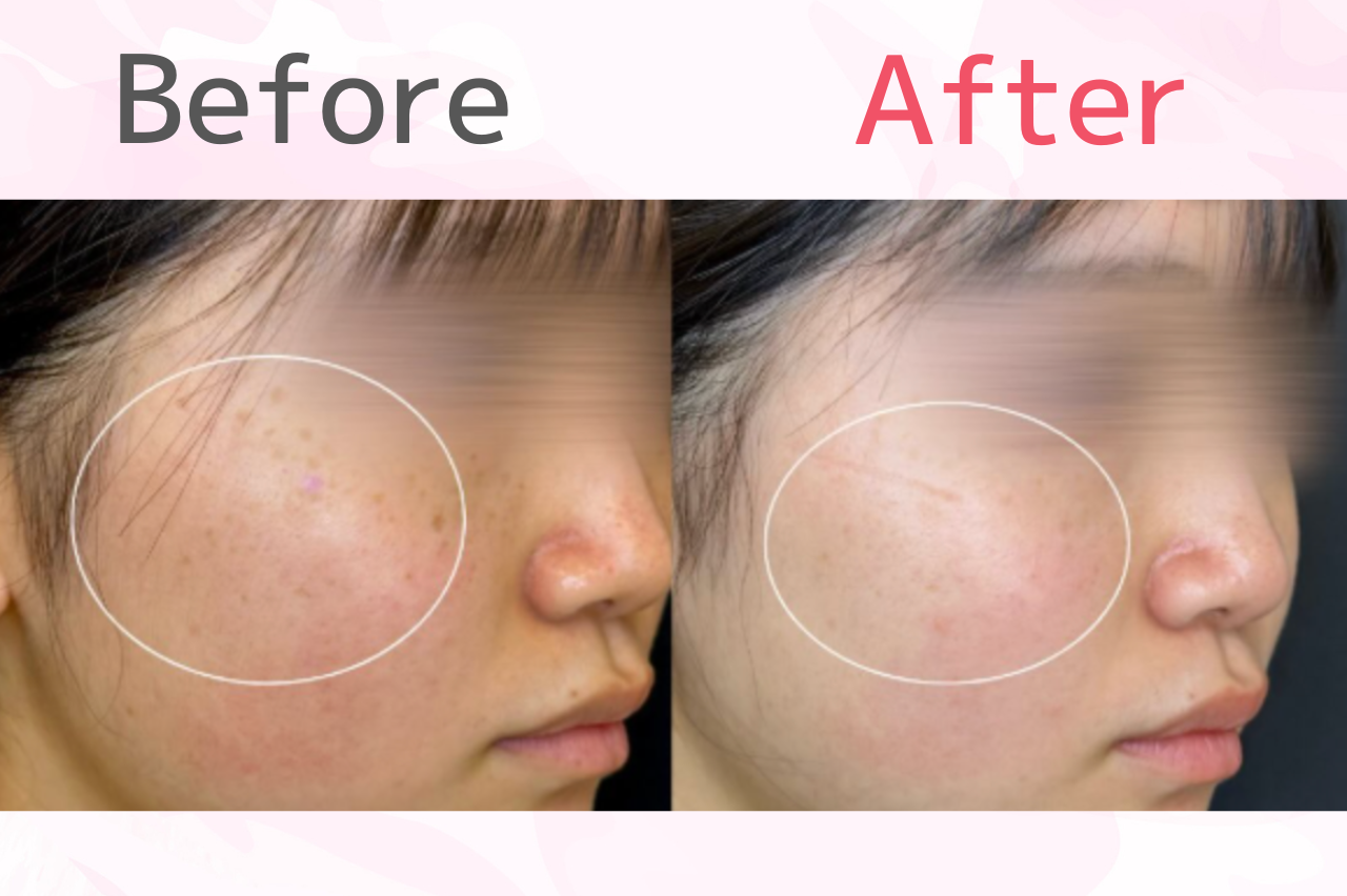 ルラクリニック　ルメッカ　口コミ　症例