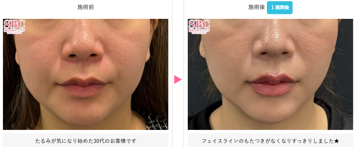 湘南美容クリニックでの糸リフトの症例