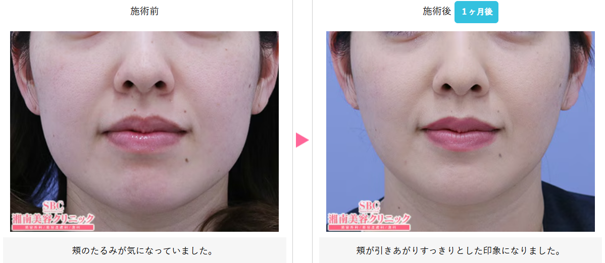 湘南美容クリニックでの糸リフトの症例2
