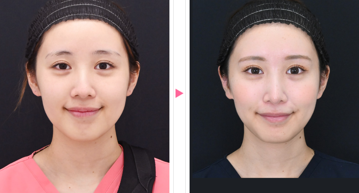 湘南美容クリニックでの糸リフトの症例4
