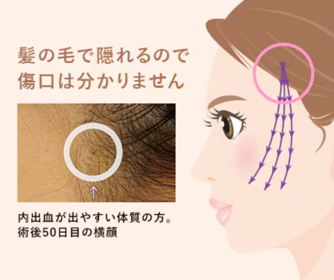 湘南美容クリニックの糸リフトで使用している鈍針カニューレ