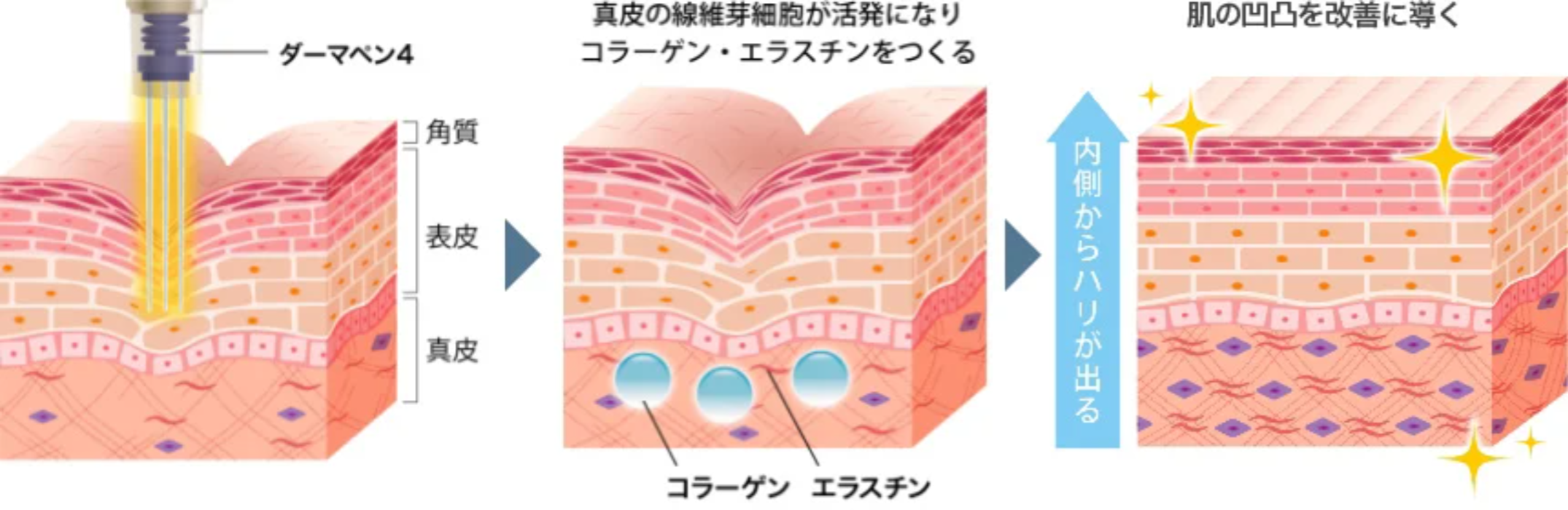 TCBのダーマペン4の仕組み