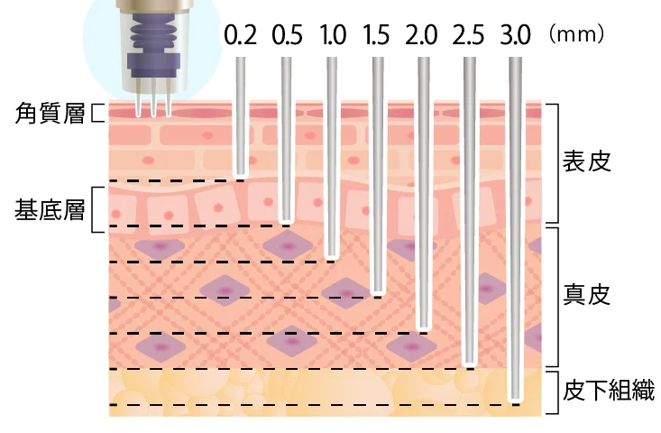 TCBのダーマペンは0.1ｍｍ単位で深さを調整できる