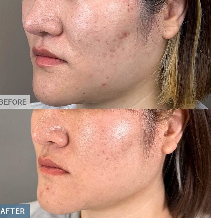 TCBダーマペン4の症例写真②