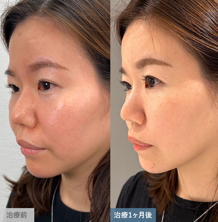 TCBダーマペン4の症例写真③