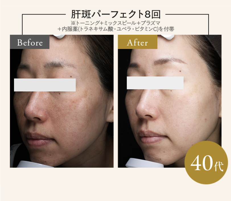 レジーナクリニック シミ取り 口コミ