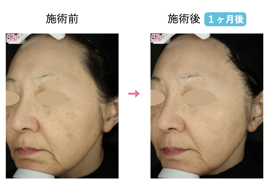 湘南　シミ取り　口コミ